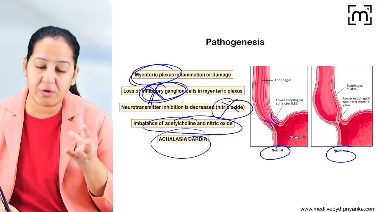 2. Achalasia