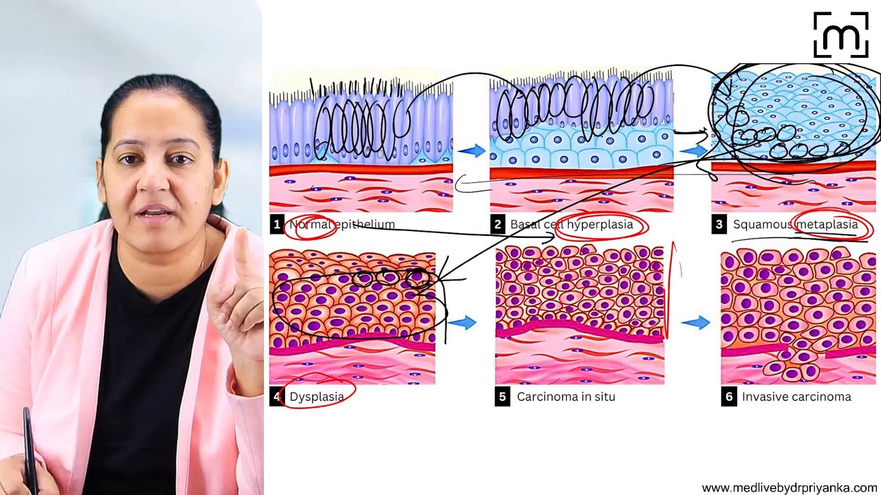 11. Lung Carcinoma