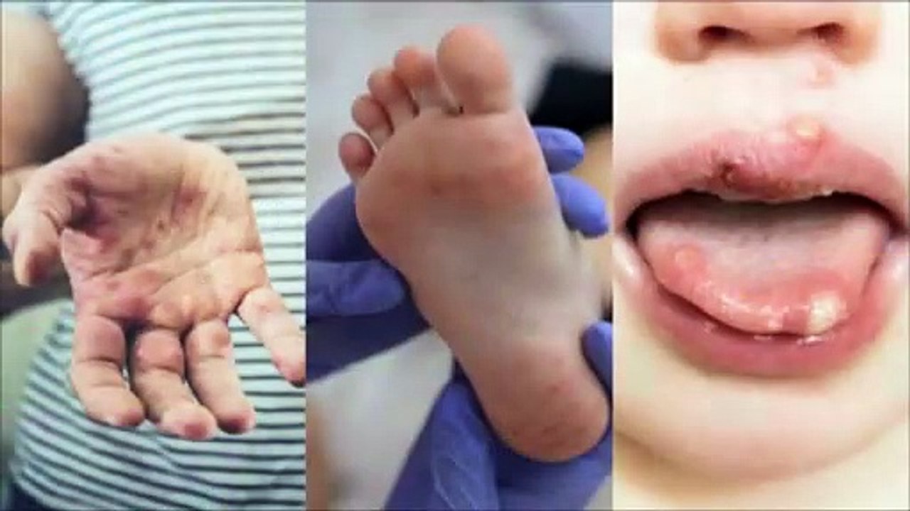 HFMD CASES DOUBLE IN TOBAGO