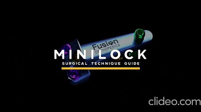 Best MiniLock Service Provider in the USA – Expert Bunion Correction Specialists