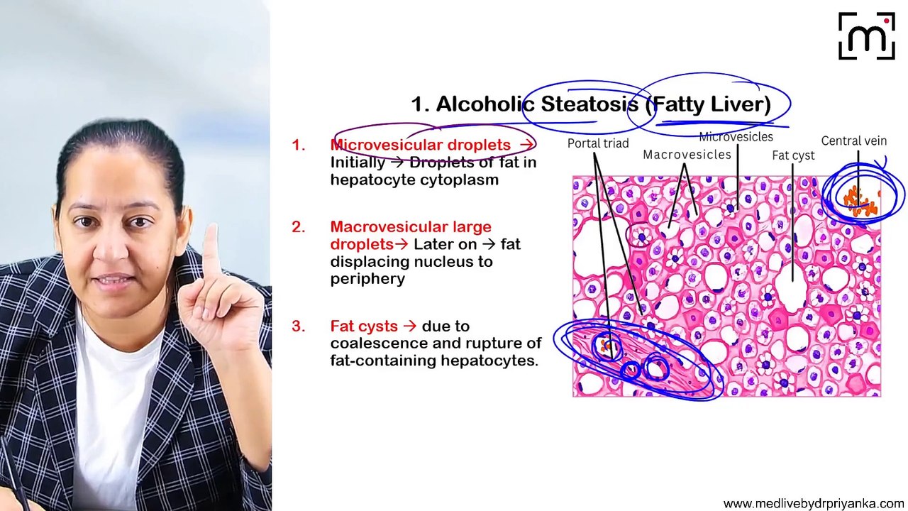 5. Alcohol Liver Disease