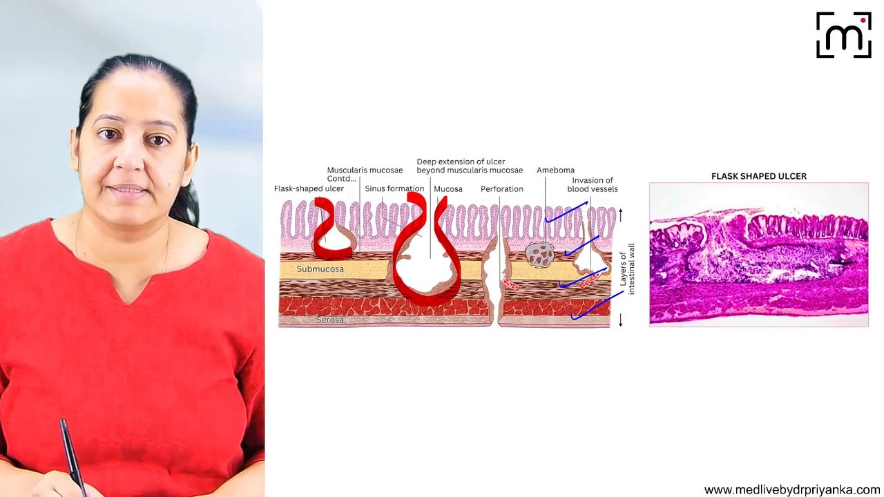 11. Pyogenic Liver Abscess,Amoebic Liver, Hydatid Disease