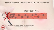 How obturational obstruction of intestine occurs?
