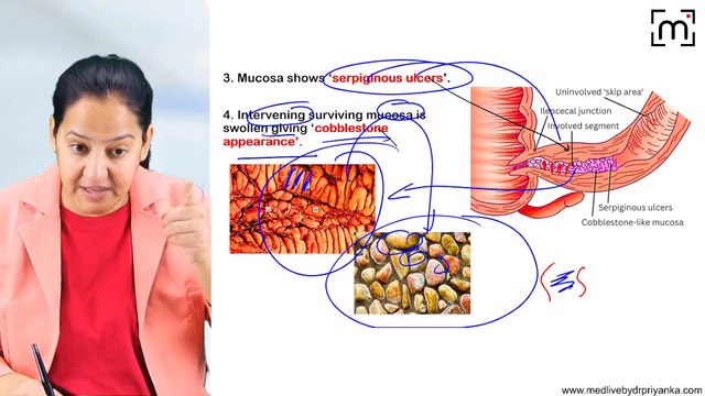 12. Inflammatory Bowel Disease - Crohn's &Ulcerative Colitis