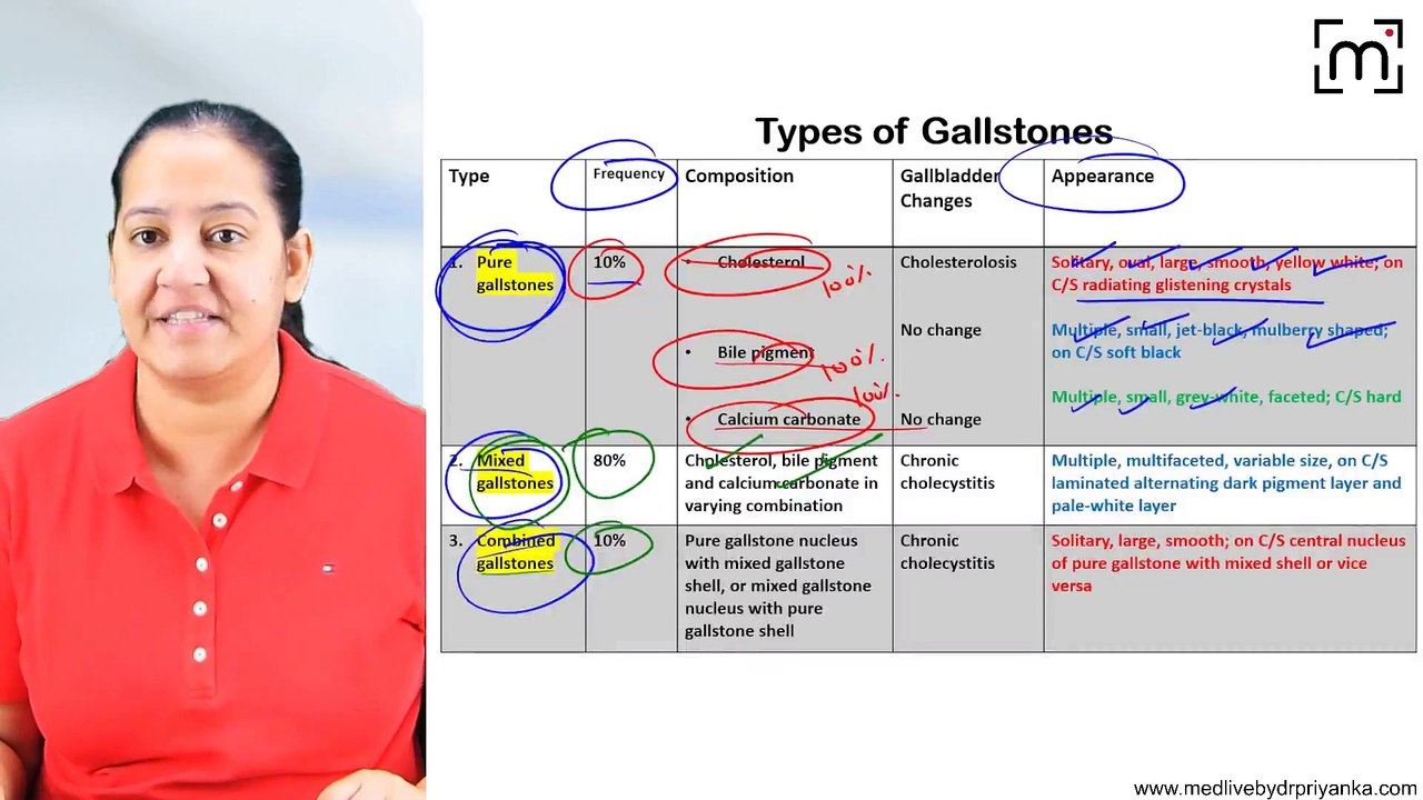 13. Cholelithiasis (Gall Stone)