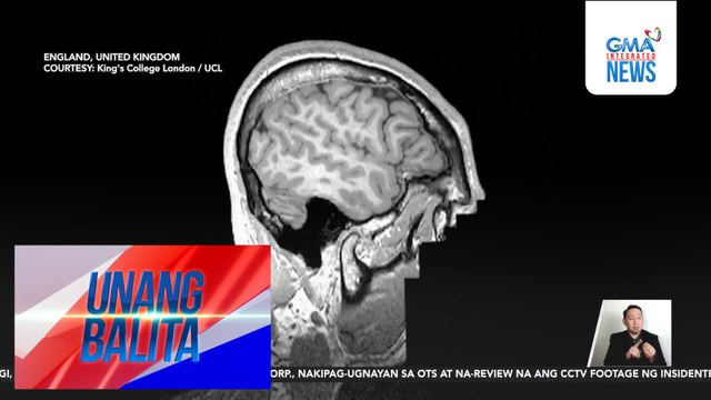 A.I. tool na Meld Graph, kayang mag-detect ng mga abnormality sa utak na nagdudulot ng epilepsy | Unang Balita