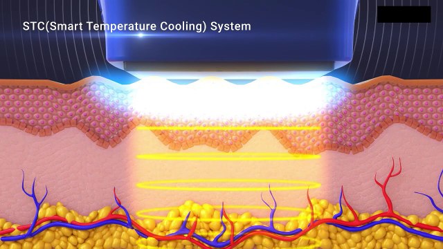 Non-Invasive Monopolar RF Skin Tightening Treatment in Singapore