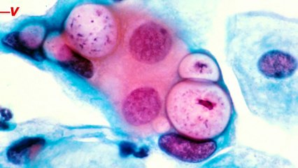 Is This United States Going Through an STI Epidemic?