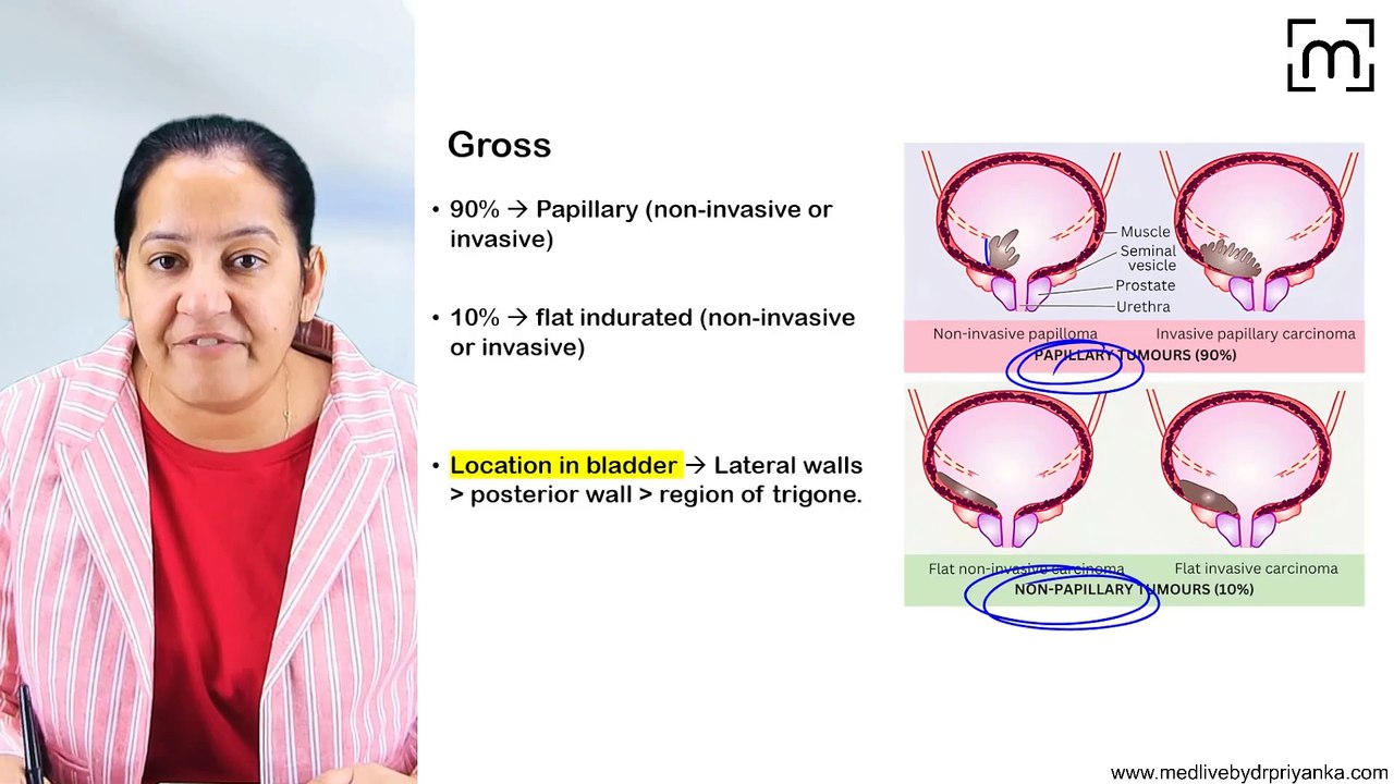 11. Bladder Carcinoma - Transitional Cell Carcinoma