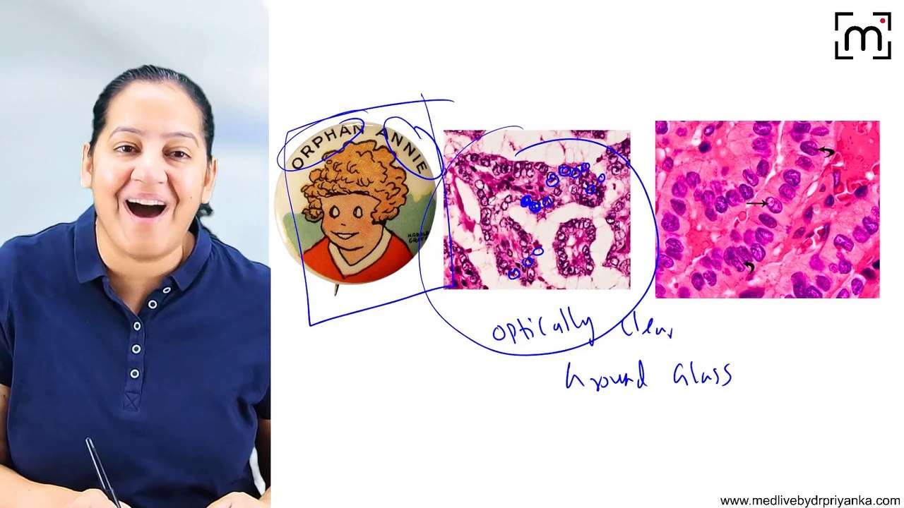 3. Thyroid Neoplsams