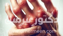 علاج التهاب المفاصل الروماتويدي #علاج #التهاب #التهابات_المفاصل #المفاصل #المفاصل_الروماتويدي #الروماتويد #التهابات