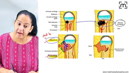 1. Osteomyelitis (Pyogenic,Tubercular)