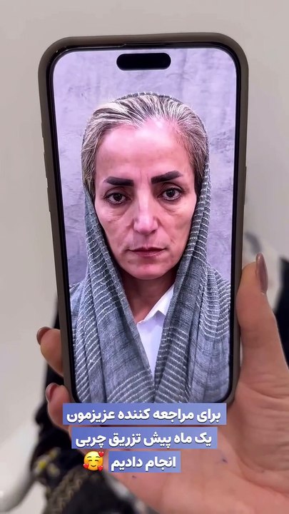 تزریق چربی به صورت: روش طبیعی جوانسازی پوست