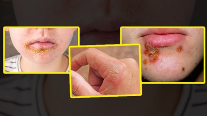 Impetigo Skin Disease Causes: इम्पेटिगो क्या है, लक्षण और बचाव | Boldsky