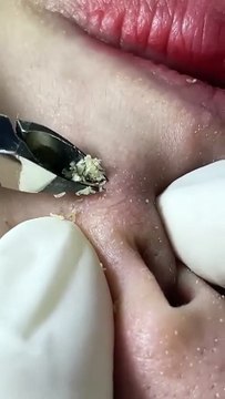 Satisfying Nose Blackhead Removal ASMR - Close-Up Facial Treatment