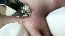 Satisfying Nose Blackhead Removal ASMR - Close-Up Facial Treatment