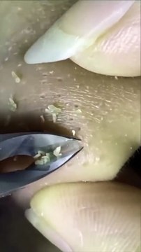 Deep Pore Cleansing ASMR - Blackhead Extraction & Facial Treatment