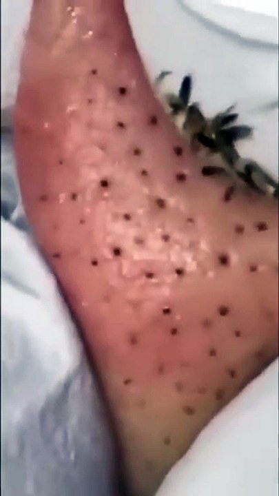 ASMR Acne Treatment Facial - Calming Sounds & Visuals