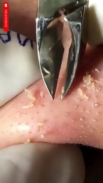 Intense Blackhead Extraction ASMR - Deep Pore Cleansing Facial