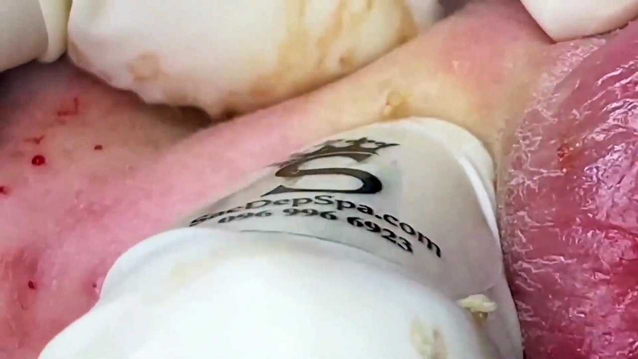 Acne Therapist's Guide to Blackhead Extraction - Tips & Tricks