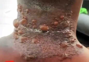 PM sofre queimaduras após ser atingido por substância química