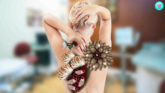 16. ASMR Remove Maggot Big Dog Ticks & Worm Infected Back Deep Cleaning Animation