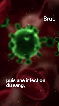 Luna Skye alerte sur les injections d'acide hyaluronique