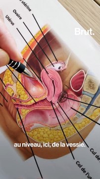 Un traitement par ultrasons contre l'endométriose au CHU de Lyon