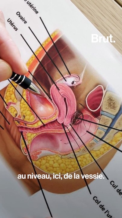 Un traitement par ultrasons contre l'endométriose au CHU de Lyon