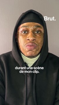 Il a pris feu sur le tournage de son clip : Soid raconte son accident