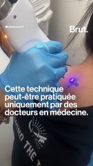 Comment fonctionne le détatouage au laser ?