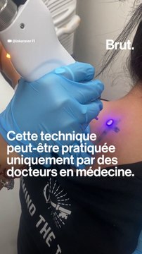 Comment fonctionne le détatouage au laser ?