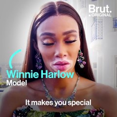 Understanding Vitiligo: Body Positivity & Self-Acceptance ✨