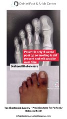 Toe Shortening Surgery – Expert Solutions for Foot Comfort