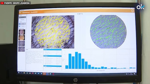 La electroporación es el tratamiento más rápido y seguro para la fibrilación auricular, la arritmia más frecuente