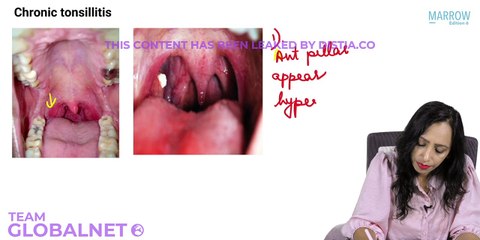56. Condition of tonsil and Tonsillectomy part 2