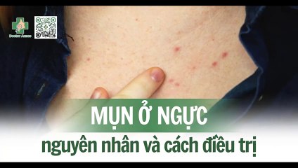 Mụn ở ngực: nguyên nhân và cách điều trị