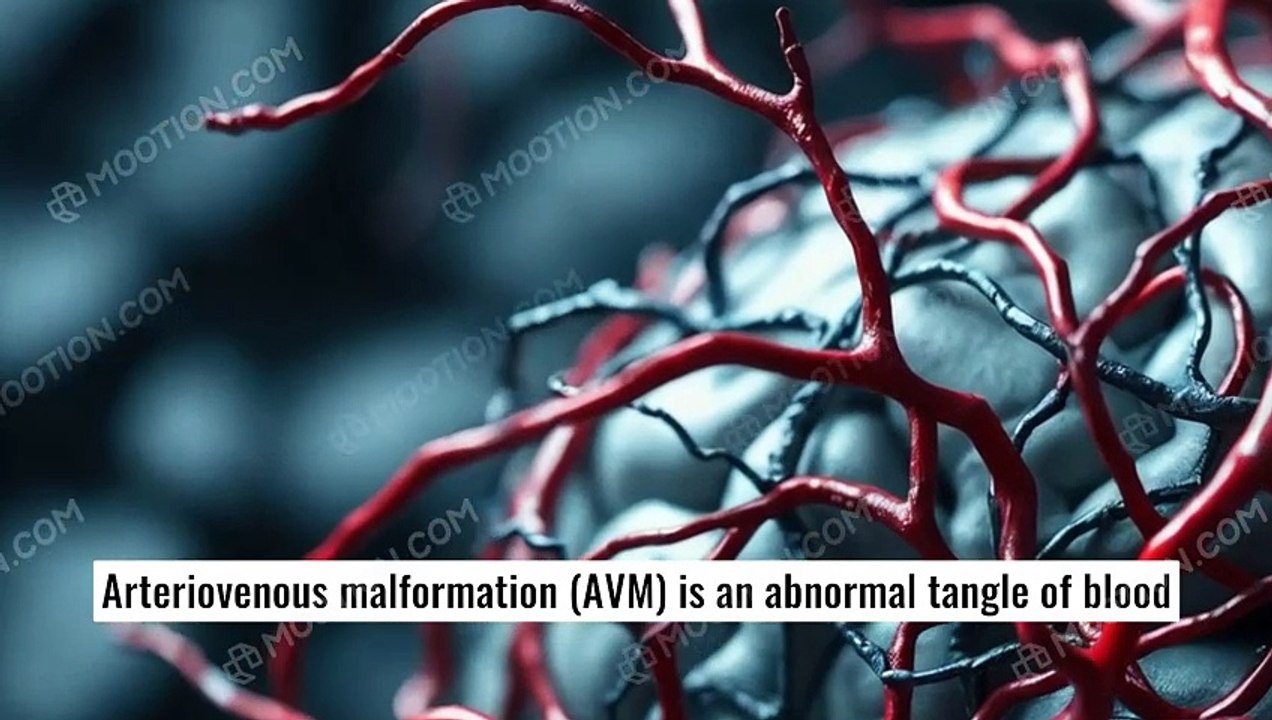 Understanding Brain Hemorrhage Causes