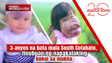 3-anyos na bata, tinubuan ng napakalaking bukol sa mukha | Kapuso Mo, Jessica Soho