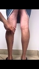 Advanced Leg Surgery in NYC – Restore Strength & Mobility
