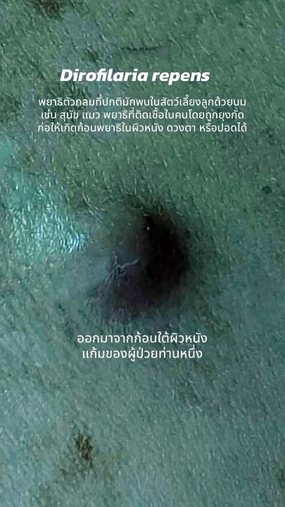 สาวคันรอบดวงตา เจอก้อนเนื้อขยับได้ หาหมอถึงกับตกใจรู้เป็นอะไร
