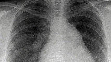 Preocupante aumento de los casos de silicosis en España