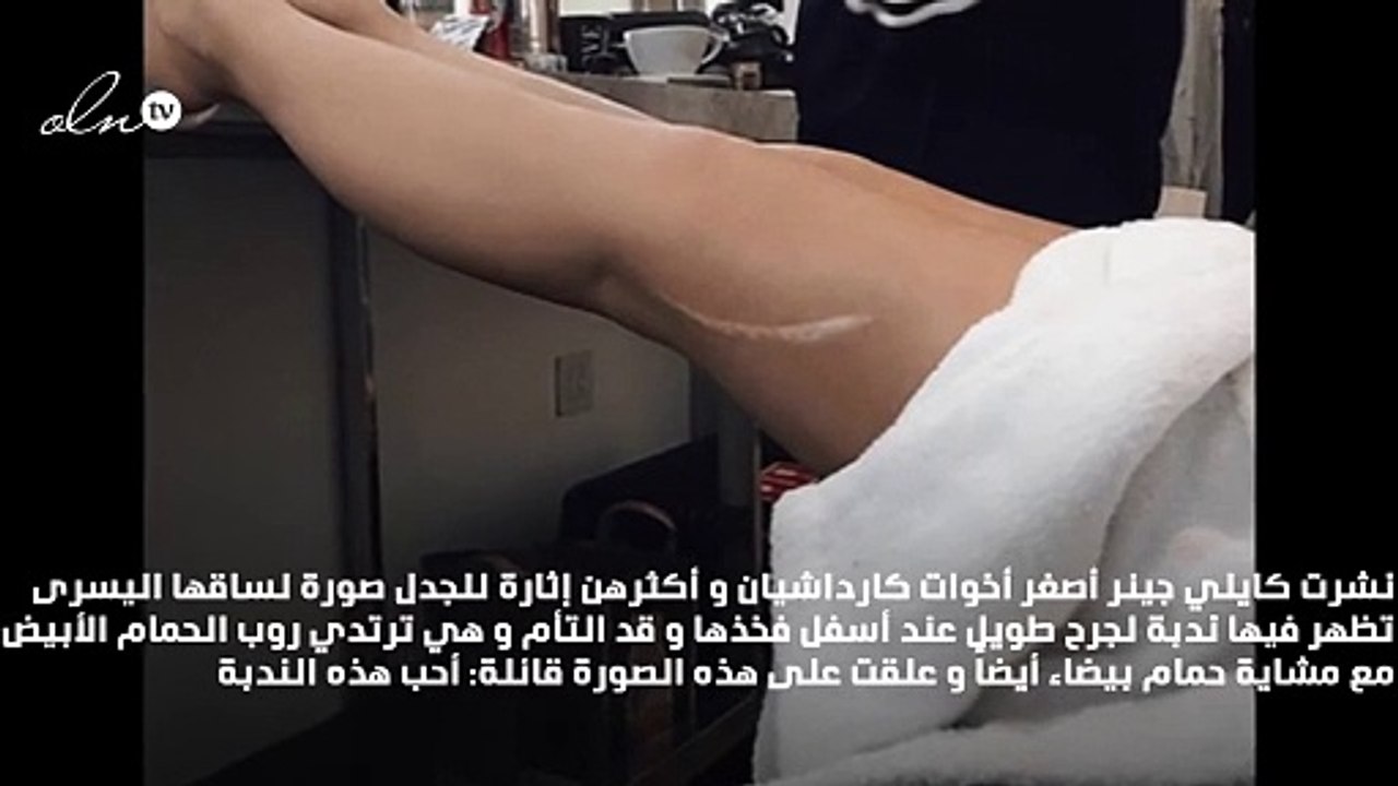 كايلي جينر تتباهى بالندبة التي على ساقها