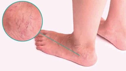 bd-arañitas-en-las-piernas-070425