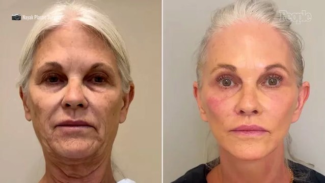 Woman, 66, Gets 9 Cosmetic Procedures During 6-Hour Plastic Surgery. Her Transformation Is Jaw-Dropping (Exclusive)