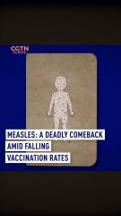 Measles: A deadly comeback