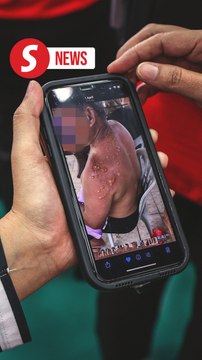 Putra Heights inferno: Special care needed for aged and ailing burn victims