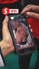 Putra Heights inferno: Special care needed for aged and ailing burn victims