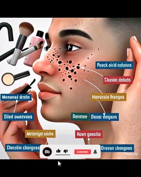 Causes and treatment of Blackheads