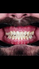 Before and After a Mouth Makeover - Your Path to a Perfect Smile